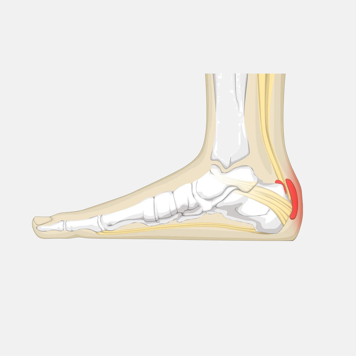 Achilles Bursitis