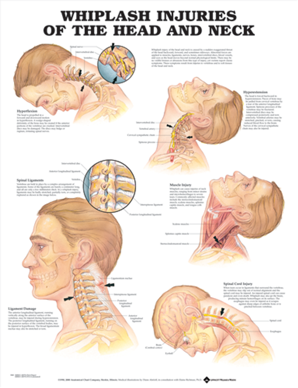 Whiplash Injuries of the Head and Neck (Laminated) - physio supplies canada