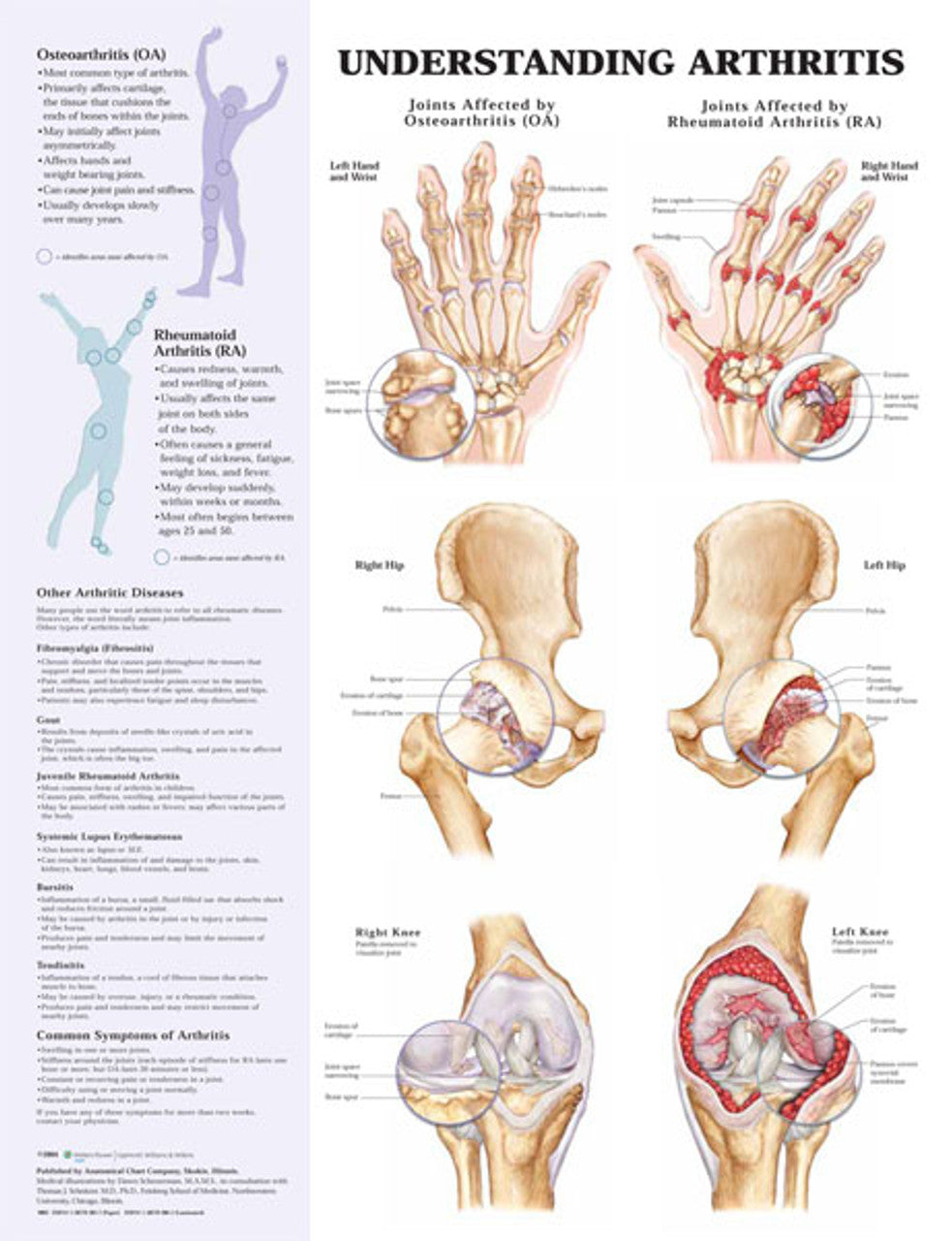 Understanding Arthritis (Laminated) - physio supplies canada